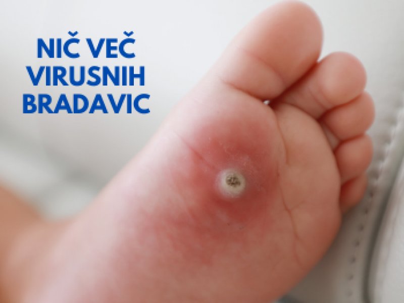 Tako sem sinu odpravila virusne bradavice