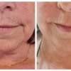 Mnenje Facelift - Katarina Plati&scaron;a
