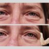 Mnenje Facelift Barbara Klikon